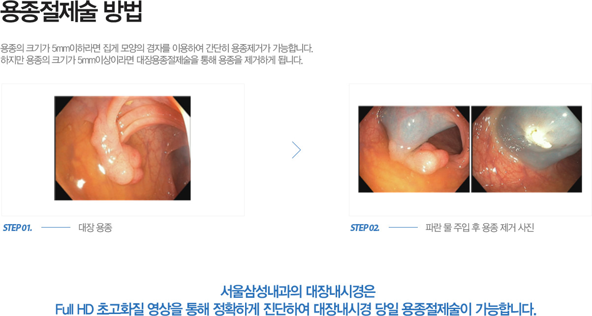  
 ũⰡ 5mm϶   ڸ ̿Ͽ  Ű մϴ. 
  ũⰡ 5mm̶̻    ϰ ˴ϴ.


Ｚ 峻ð
Full HD ʰȭ   Ȯϰ Ͽ 峻ð   մϴ. 
